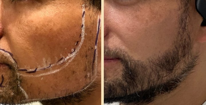 Un boom impensado: implante capilar de barbas
