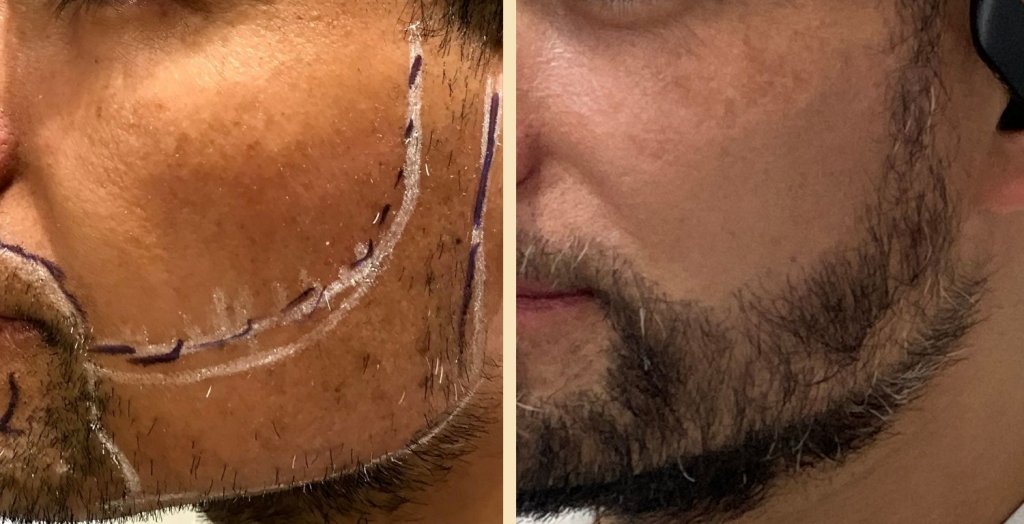 Un boom impensado: implante capilar de barbas