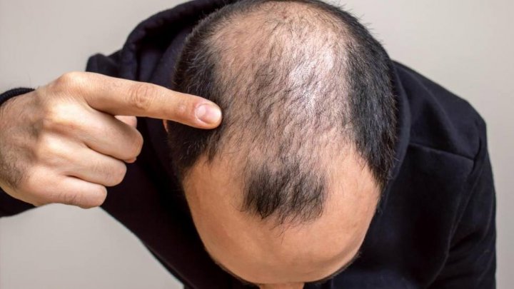 Transplante capilar: ¿cuándo es un buen momento para hacerlo?