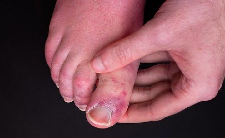 Dedos morados en el pie: otro de los efectos del Covid