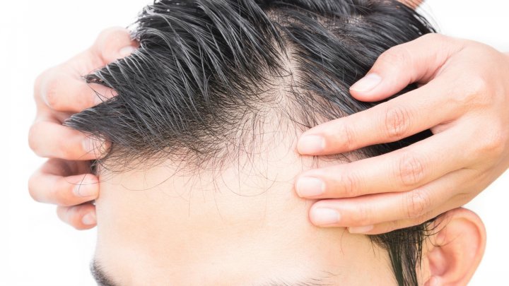 Caída de pelo por stress: como combatir el drama que acecha a hombres y mujeres